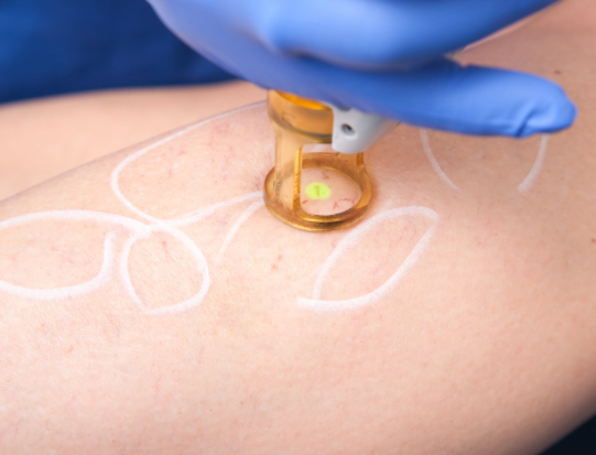 Vascular and Laser Facials